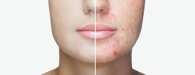 Acne littekens behandelen