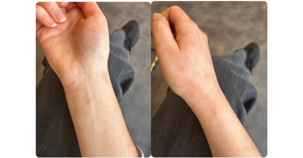 Voor en na resultaat eczeembehandeling met Dermasence Vitop Forte Rescue Care Cream bij AJ Skin Clinic.