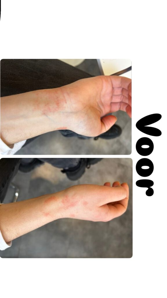 Voor en na resultaat eczeembehandeling met Dermasence Vitop Forte Rescue Care Cream bij AJ Skin Clinic.