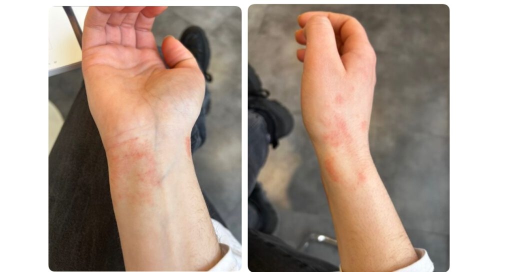 Voor en na resultaat eczeembehandeling met Dermasence Vitop Forte Rescue Care Cream bij AJ Skin Clinic.